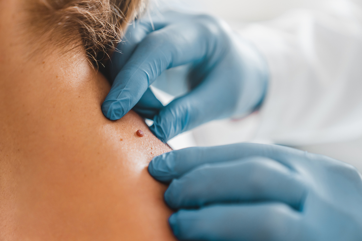 gloved hands examining a skin tag on a patient's neck