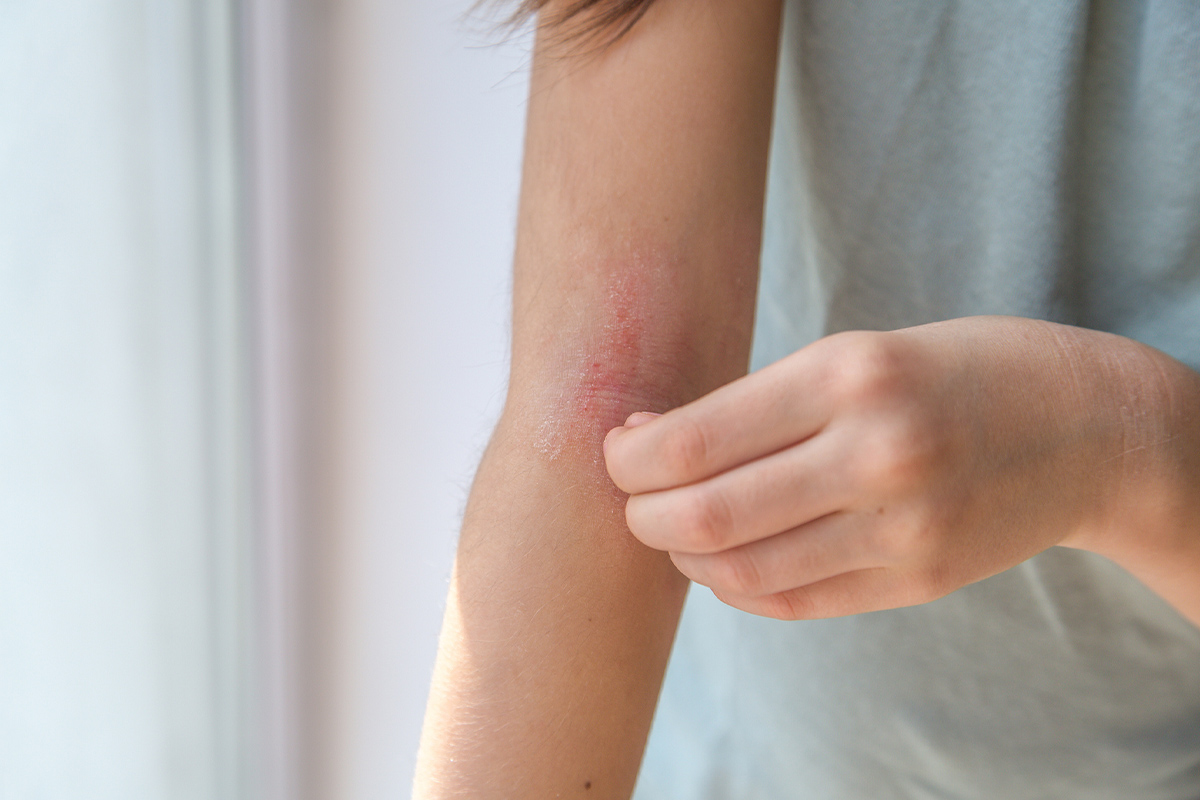 a woman with eczema looking at her red arm